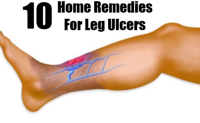 10 Effective Home Remedies For Leg Ulcers