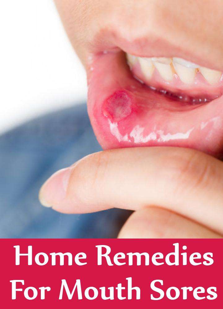 11 Home Remedies For Mouth Sores