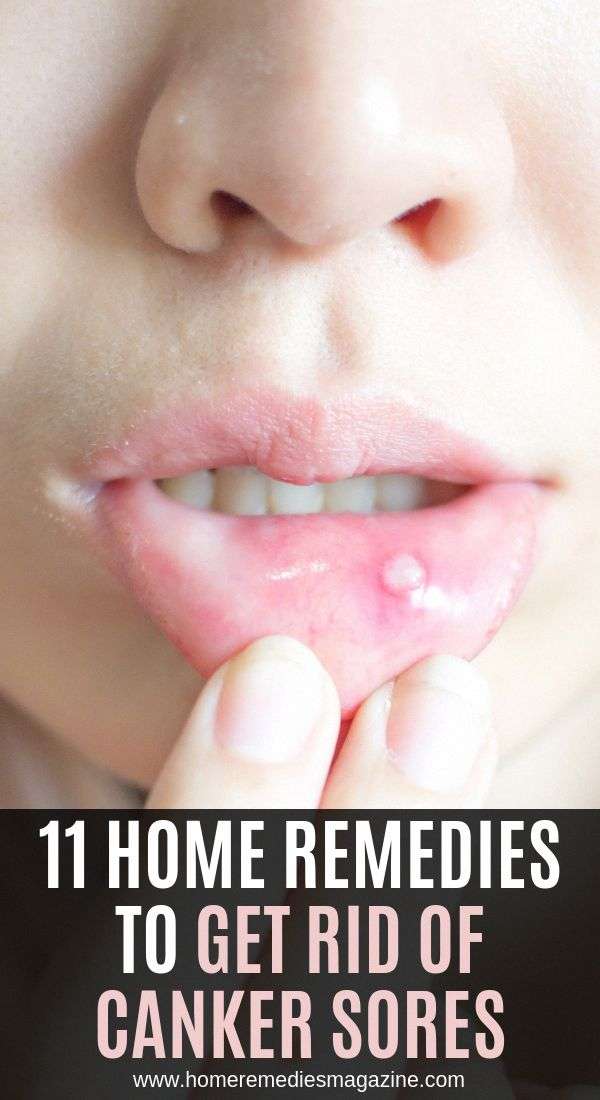 11 Home Remedies to Get Rid of Canker Sores #ImportanceOfOralHygiene # ...