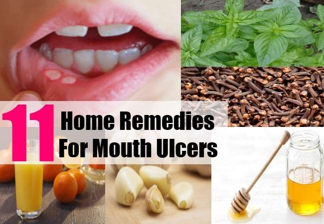 11 Natural Home Remedies for Mouth Ulcers