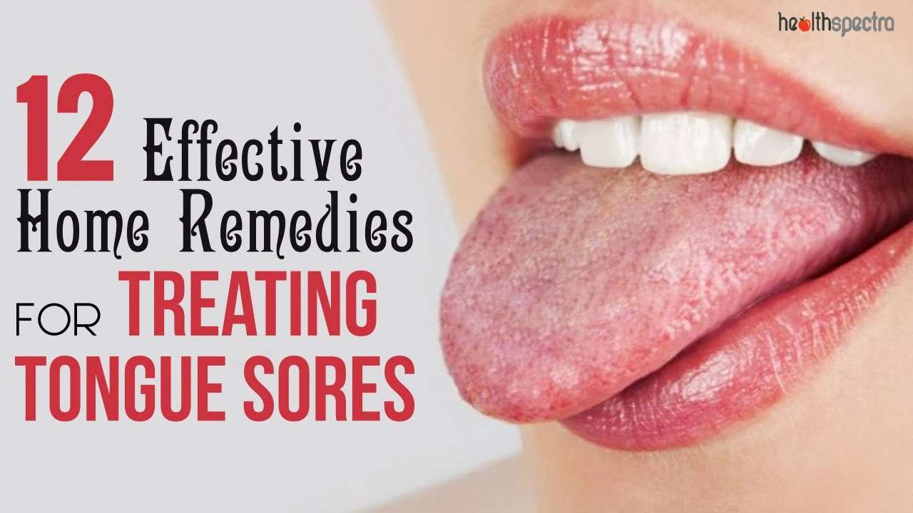 12 Effective Remedies For Treating Tongue Sores ...