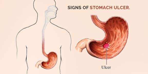 14 Ways to Permanently Cure Stomach Ulcer