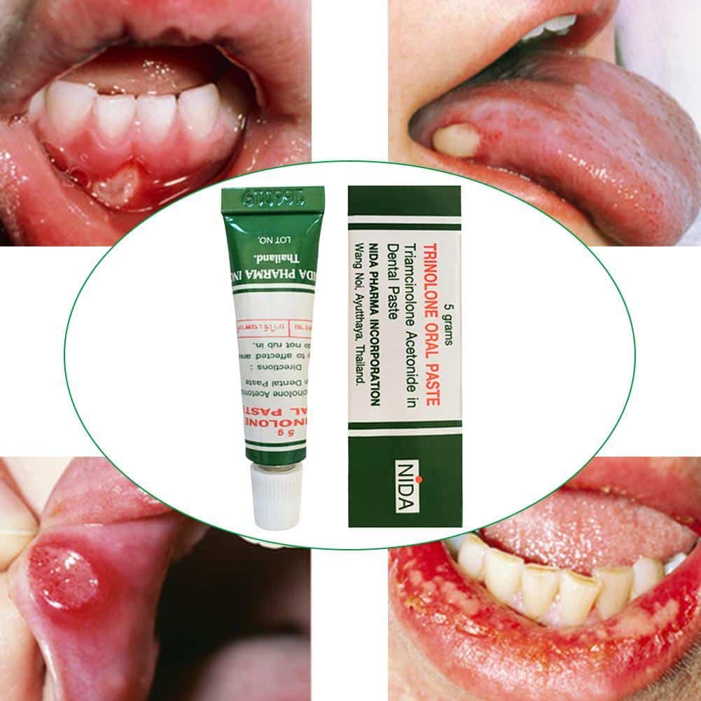 1pcs Oral Care Mouth Ulcer Relief Gel Natural Herbal Oral Antibacterial ...