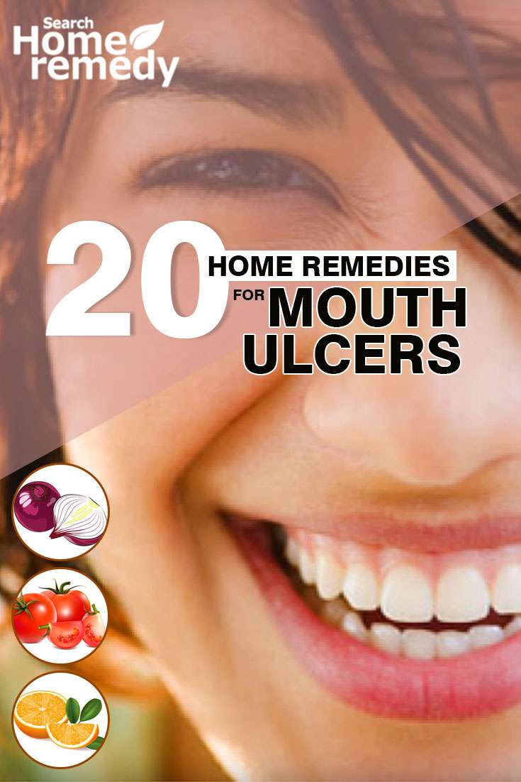 20 Home Remedies For Mouth Ulcers
