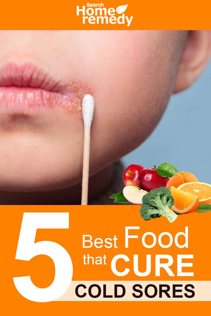 5 Best Food That Cure Cold Sores, Treat Cold Sores Naturally