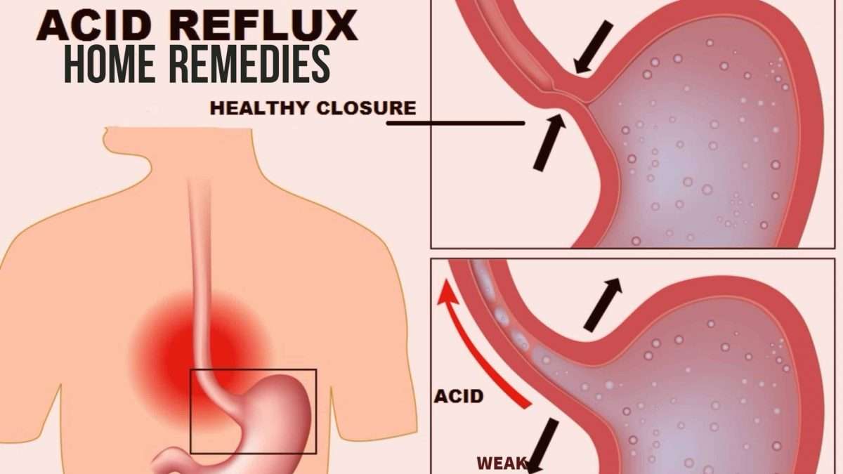 5 Best Home Remedies for Acid Reflux
