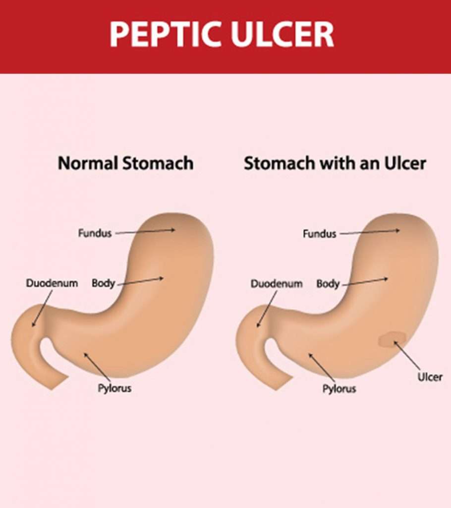 7 Symptoms Of Stomach Ulcer In Children And Its Treatment