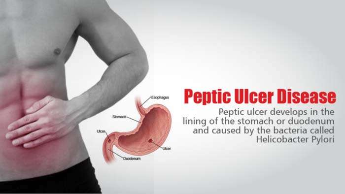 9 Effective Home Remedies For Peptic Ulcer