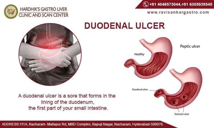 A duodenal ulcer is a sore that forms in the lining of the duodenum ...