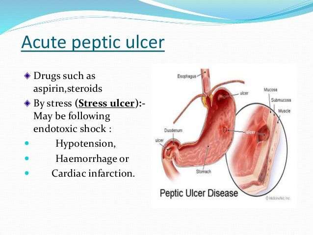 Acute peptic ulcer