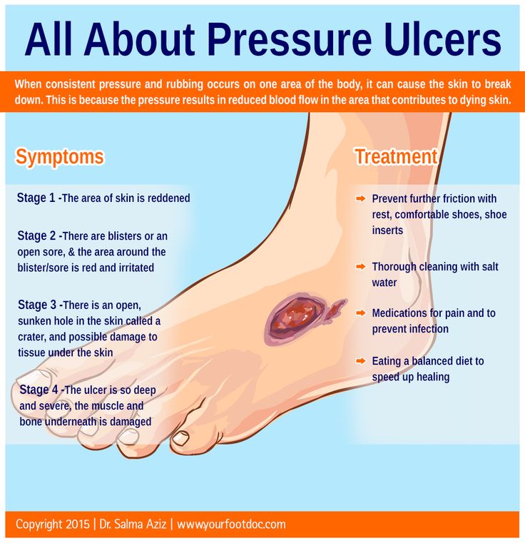 All About Pressure Ulcers