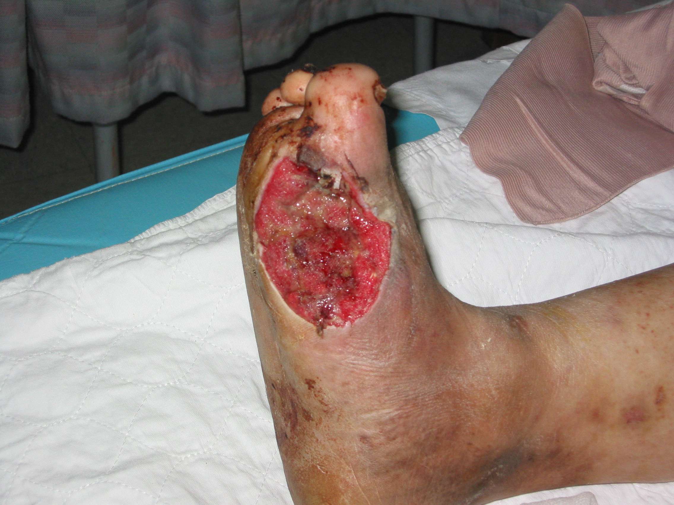 Amniotic graft diabetic foot ulcers