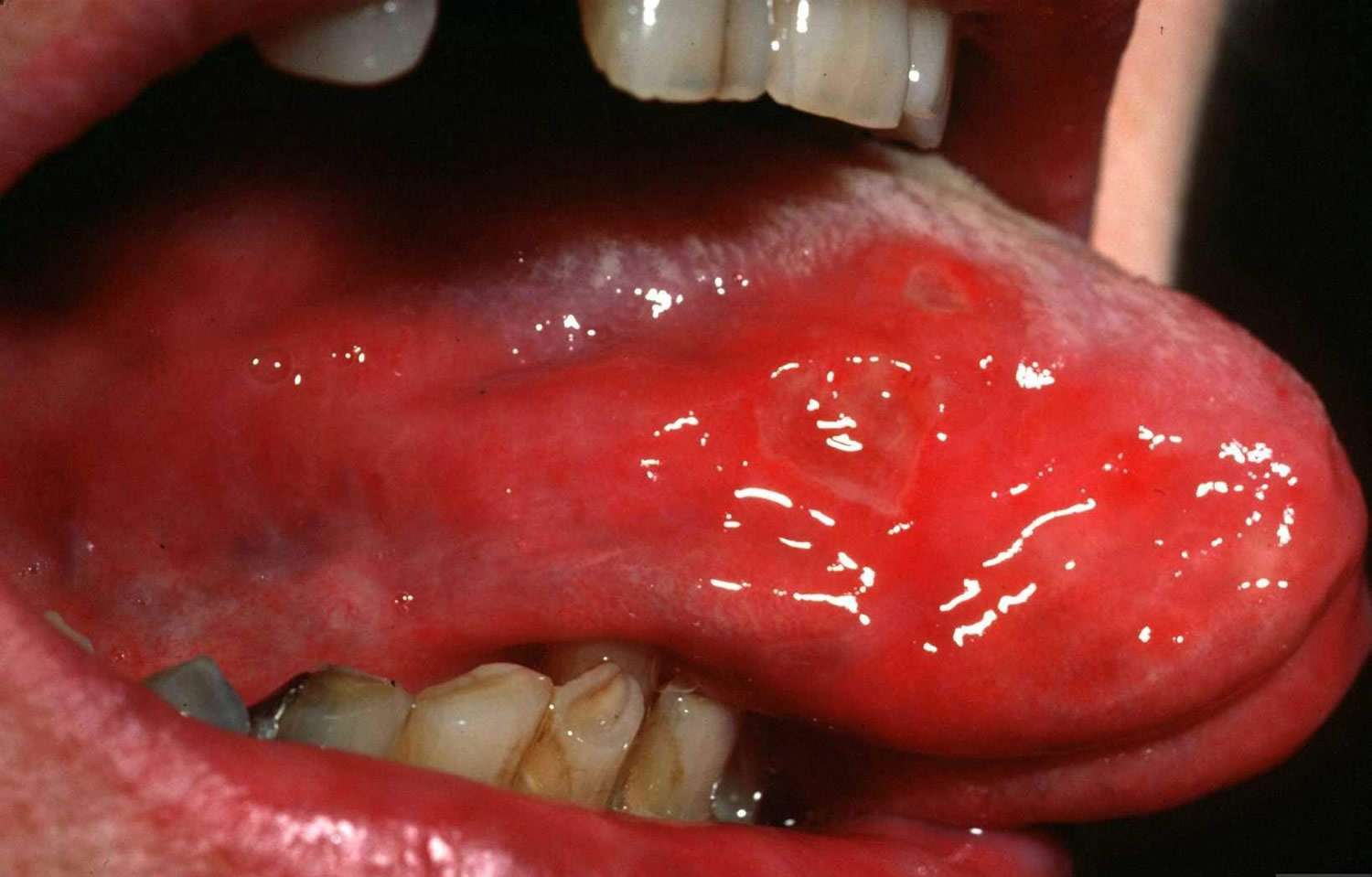 Aphthous stomatitis, aphthous ulcer causes &  aphthous ...