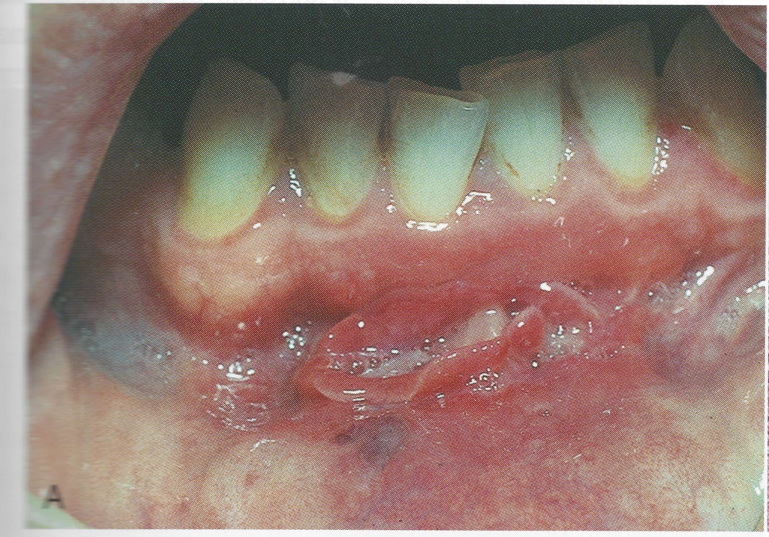 Aphthous Ulcers (Canker Sores)
