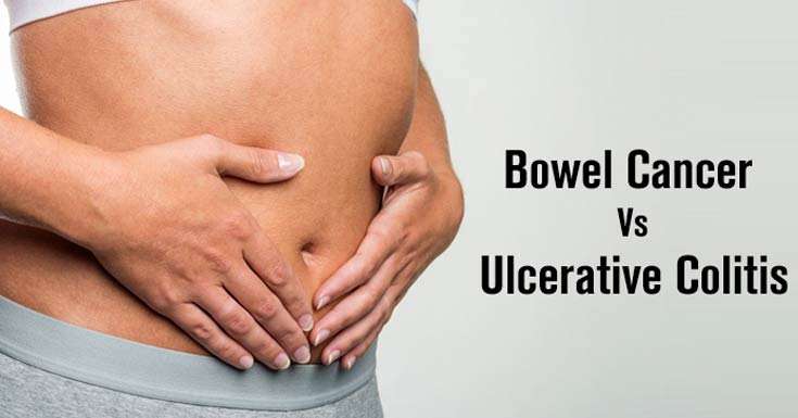 Are The Bowel Cancer Symptoms Similar To An Ulcerative ...