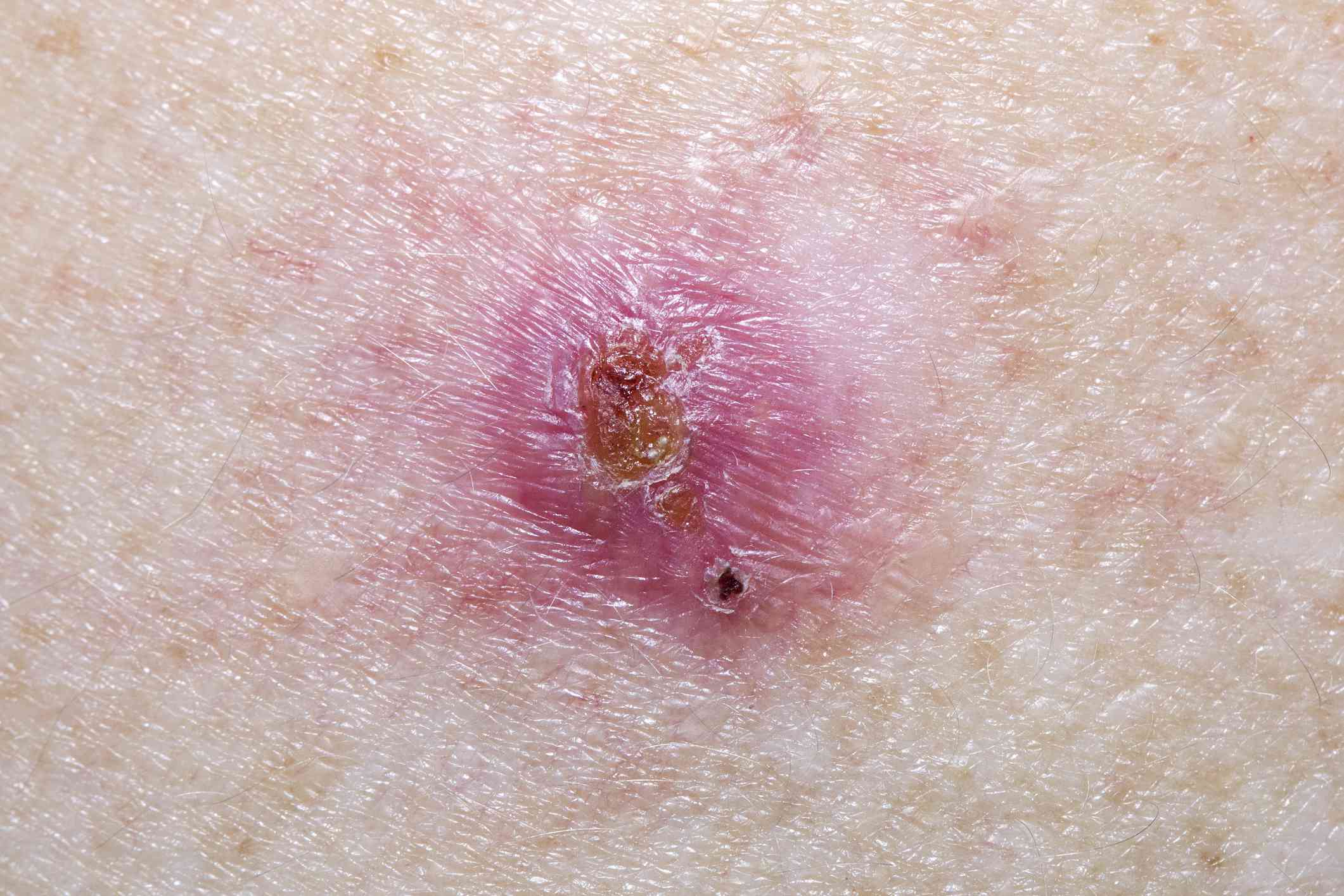 Basal Cell Carcinoma Pictures
