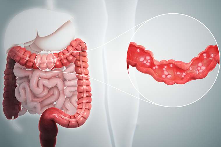 Best Ulcerative Colitis Treatment in India