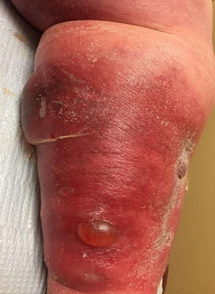 Blood Clot in Foot