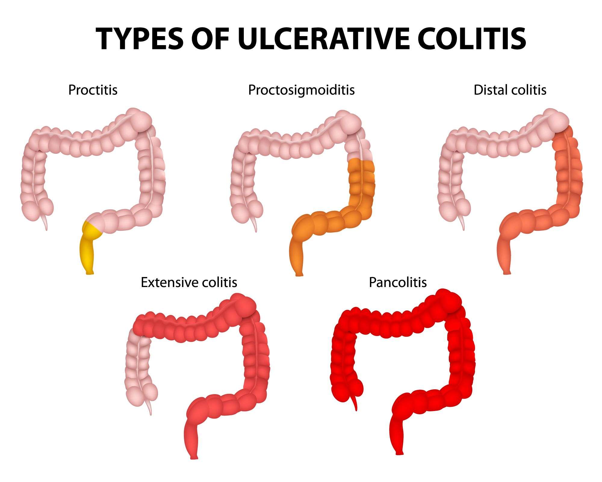 Bloody Stool Ulcerative Colitis