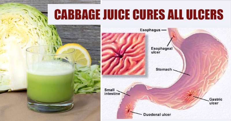 Cabbage Juice Cures Every Single Patient Of Stomach Ulcers ...