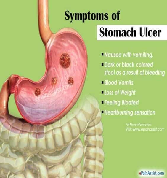 Can Coffee Cause Peptic Ulcer