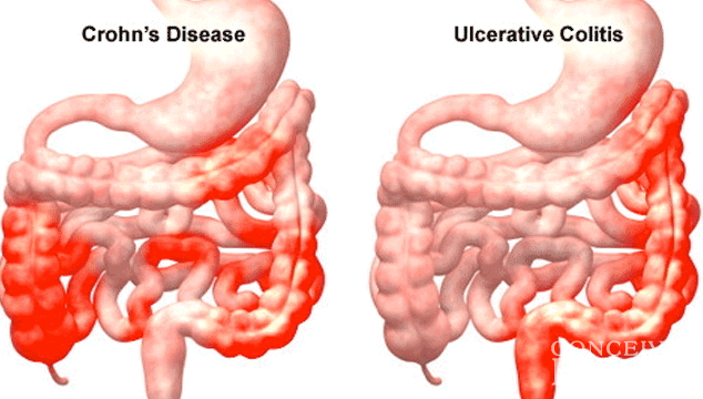 Can I get Pregnant with Ulcerative Colitis?