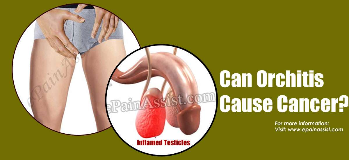 Can Orchitis Cause Cancer &  Does It Cause Back Pain?