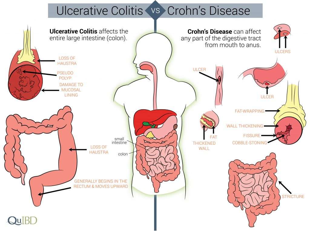 Can You Have BOTH Crohns Disease and Ulcerative Colitis ...
