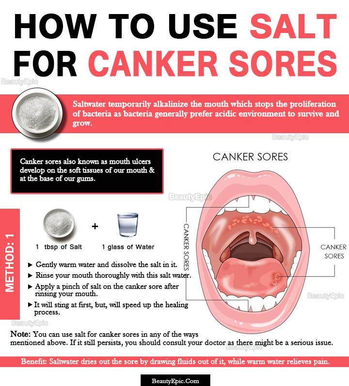 Canker Sore On Tongue Treatment