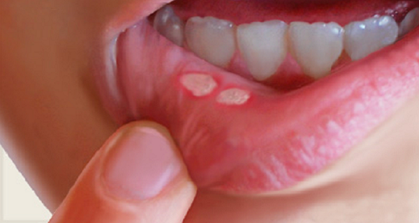 Canker Sores In The Mouth: Here Is How To Naturally Get Rid Of Them In ...