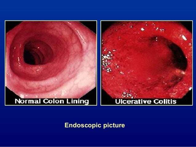 Celiac Disease Ulcerative Colitis