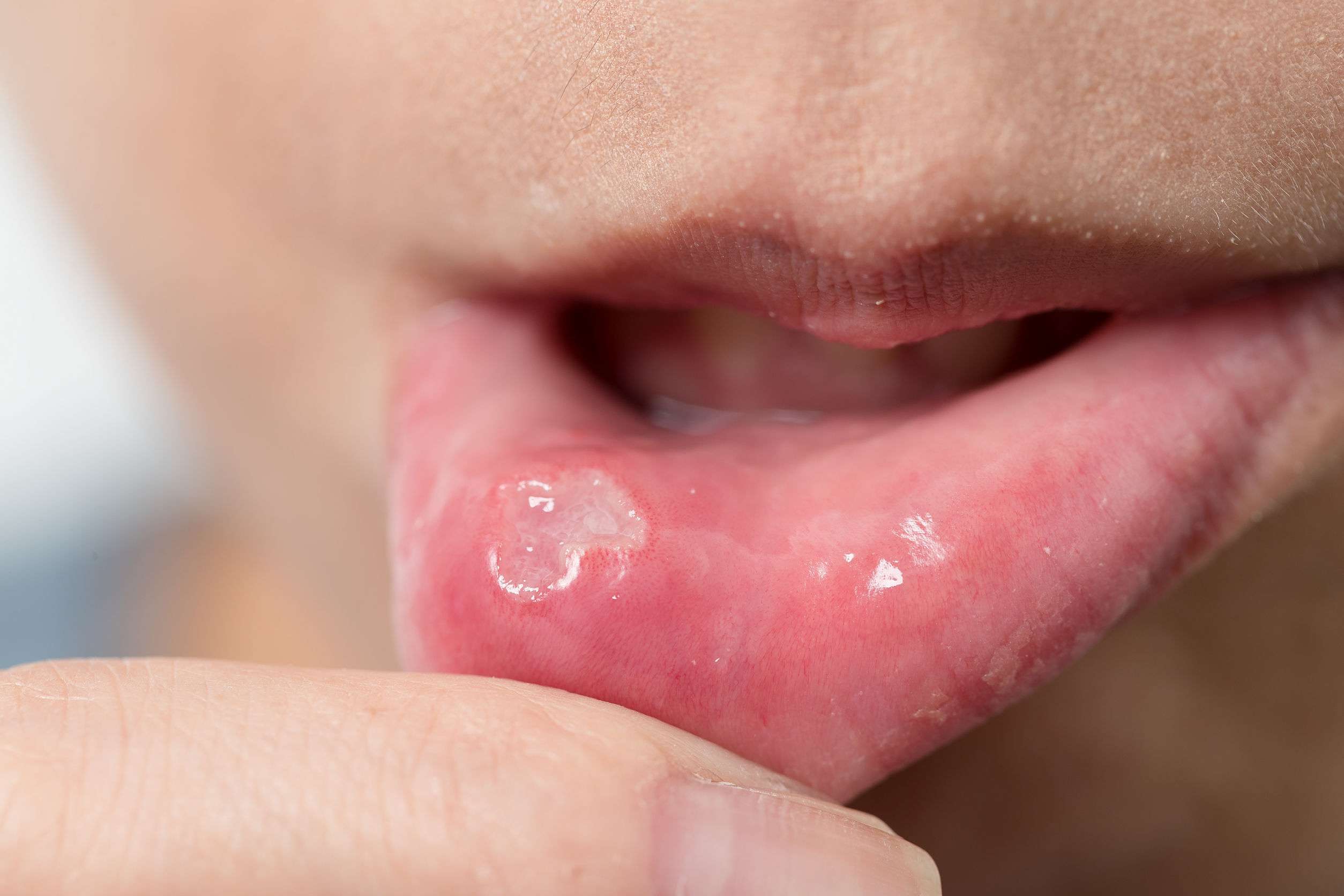 Cold Sores, Canker Sores and Gluten
