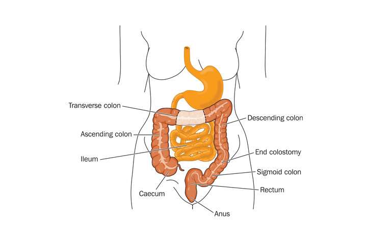 Colectomy surgery for IBD