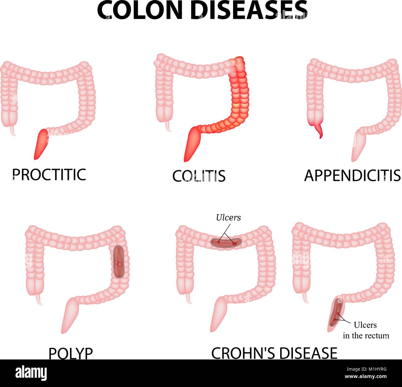Colon diseases. Proctitis, colitis, appendicitis, polyp, ulcer, Crohn
