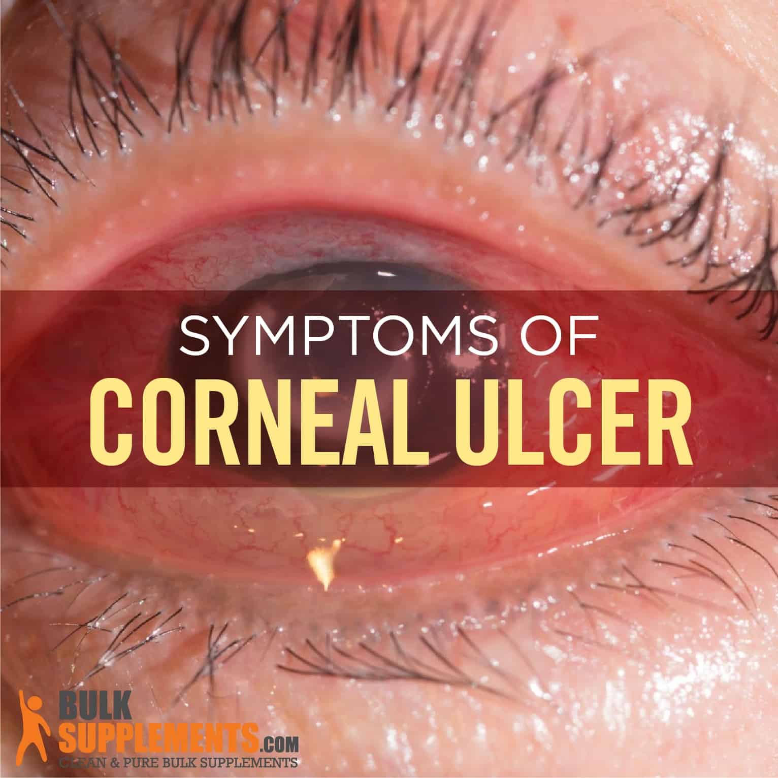 Corneal Ulcer: Characteristics, Causes &  Treatment