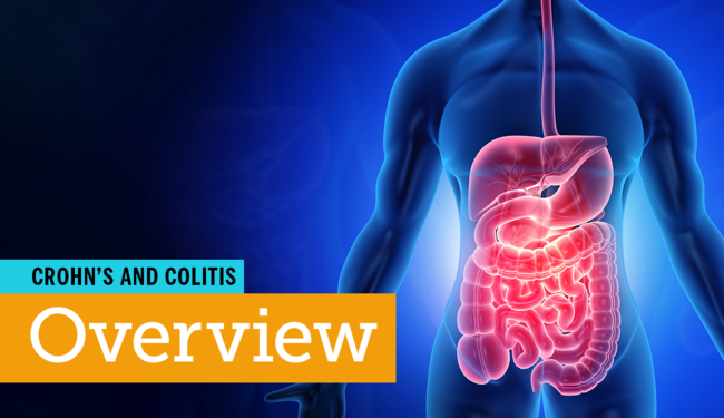 Crohnâs Disease and Ulcerative Colitis â Overview ...
