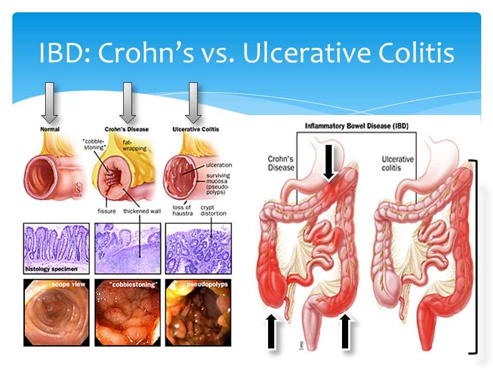 Crohns Disease vs Ulcerative Colitis : IBD