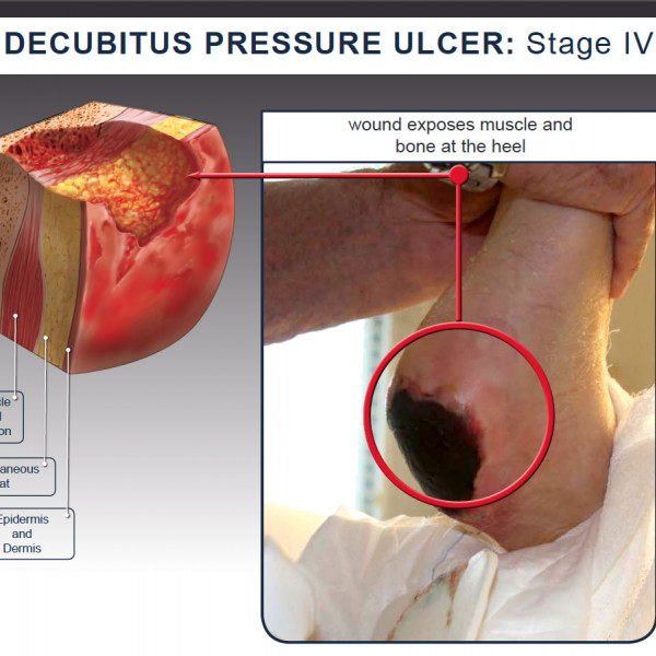 Decubitus Pressure Ulcer: Stage IV