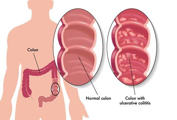 designfxsolution: Ulcerative Colitis Inflamed Colon