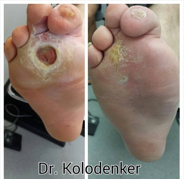 diabetic.foot.surgery.orange.county.wound.expert.ulcer.heal