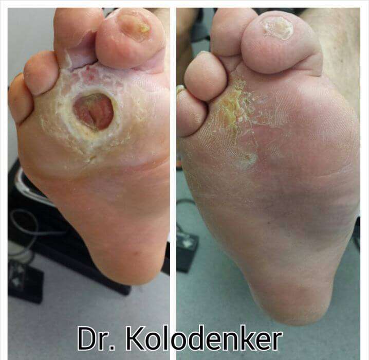 diabetic.foot.surgery.orange.county.wound.expert.ulcer ...