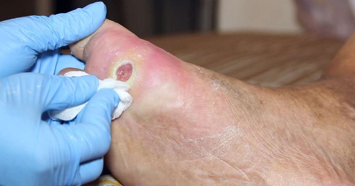 Diabetic Foot Ulcer and Wound