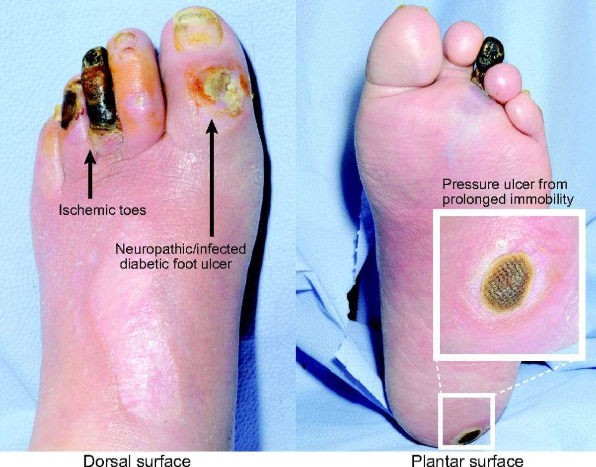 Diabetic foot ulcer pictures 1