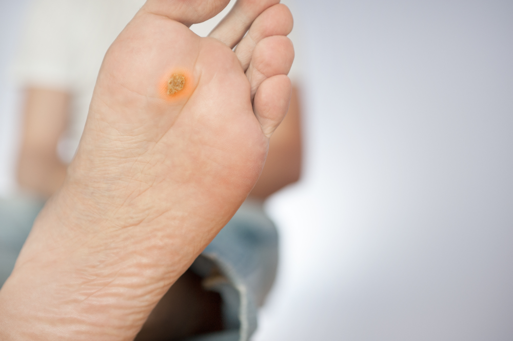 Diabetic Foot Ulcers: Why Diabetics Are at Higher Risk, Symptoms ...