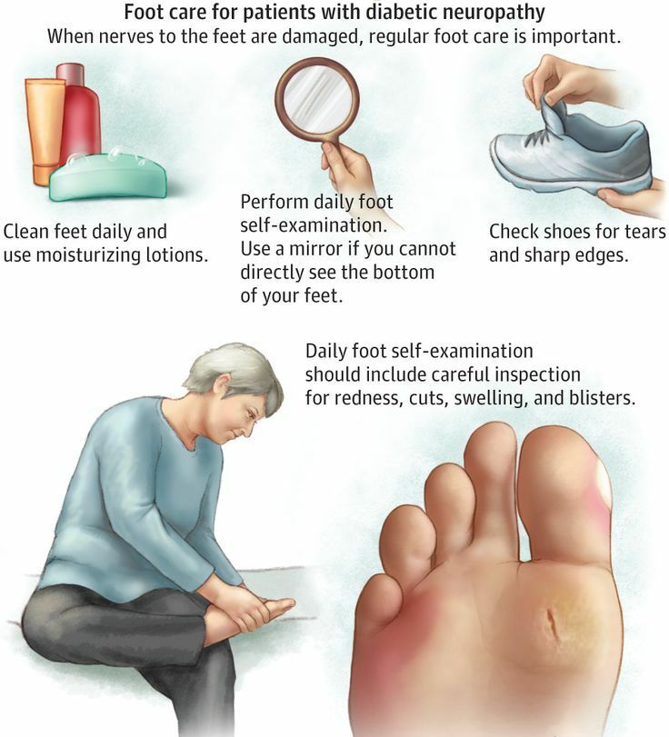 Diabetic Neuropathy and Your Feet