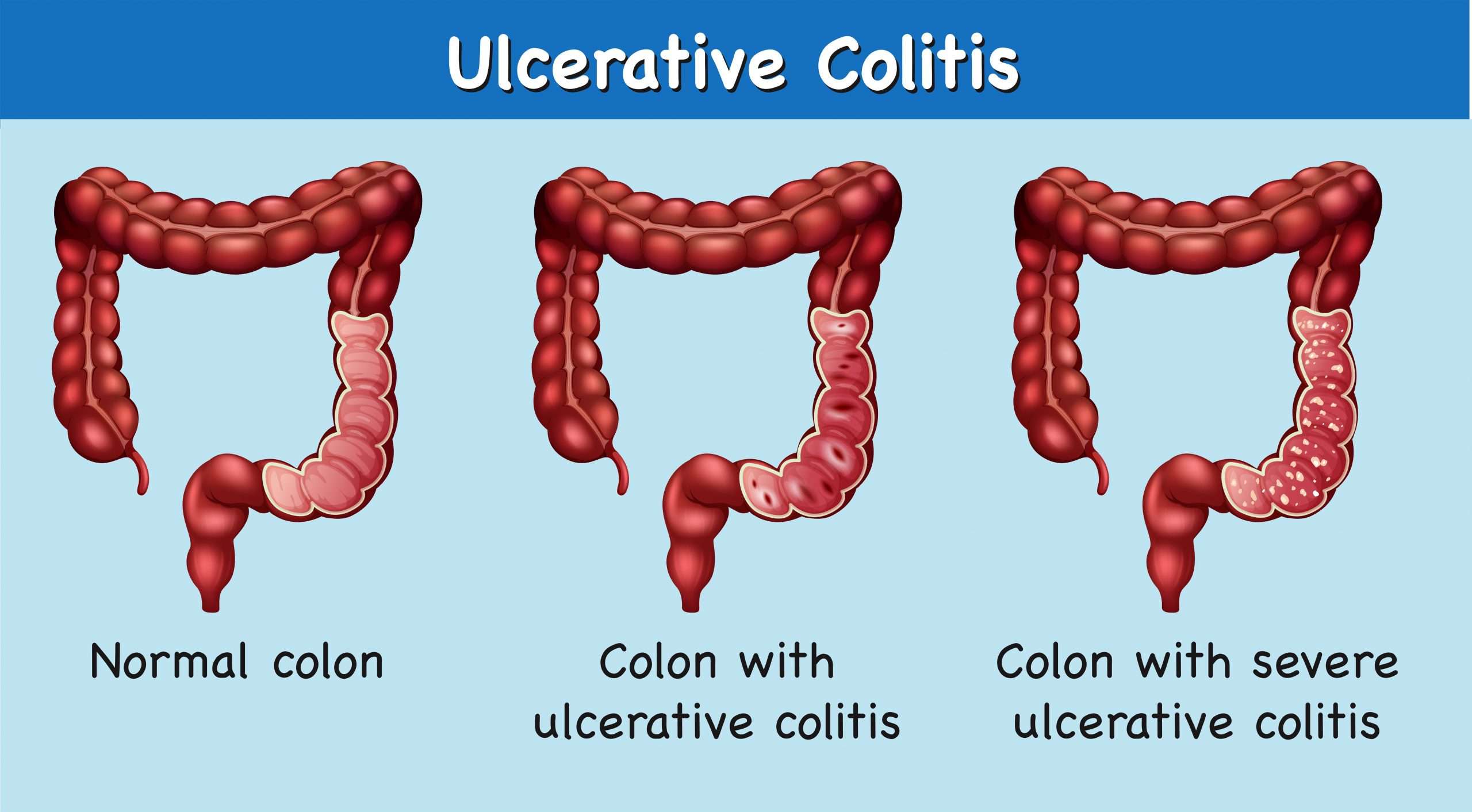 Diagram showing ulcerative colitis 302827 Vector Art at ...