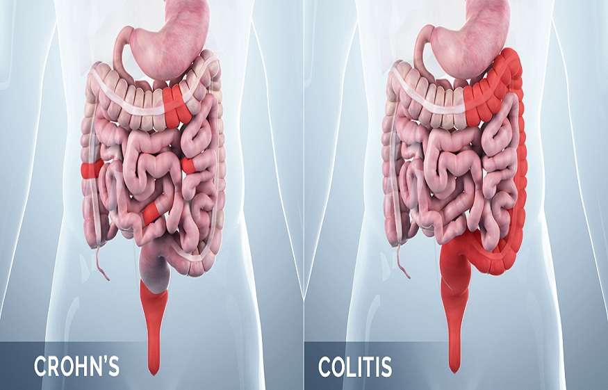 Differences between Crohn