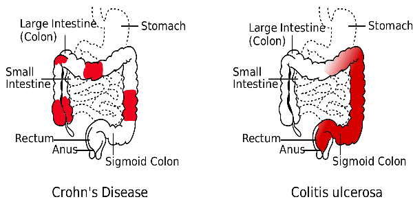 DIFFERENCES BETWEEN CROHNS DISEASE AND ULCERATIVE COLITIS ...