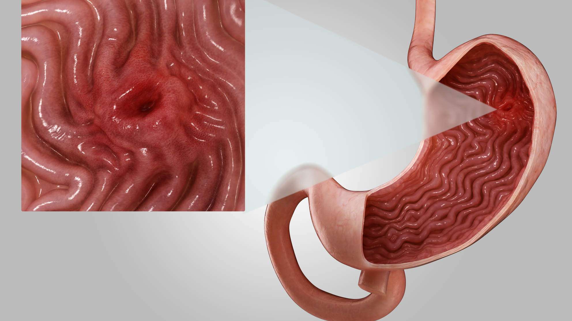 Does Stress Really Cause Stomach Ulcers? Here