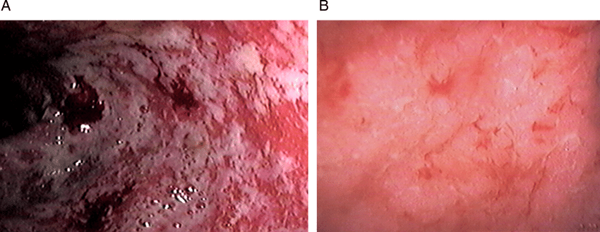 Endoscopic picture of ulcerative colitis with (A) Mayo ...